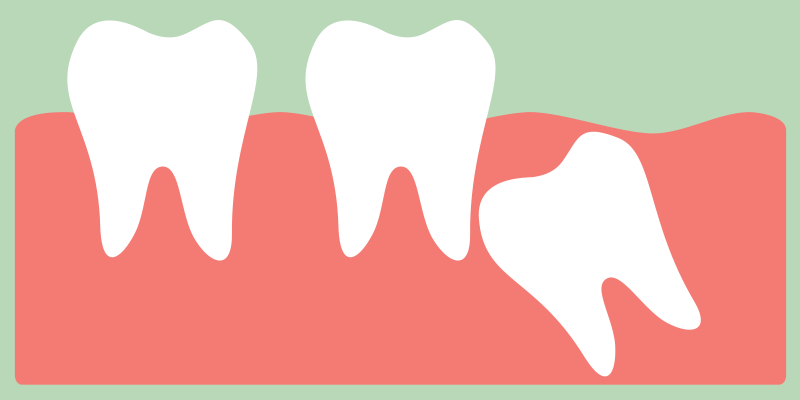 wisdom tooth emerging from the gums